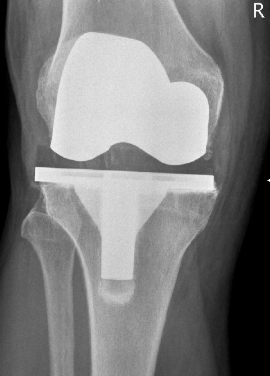 Knee replacement implant X-ray